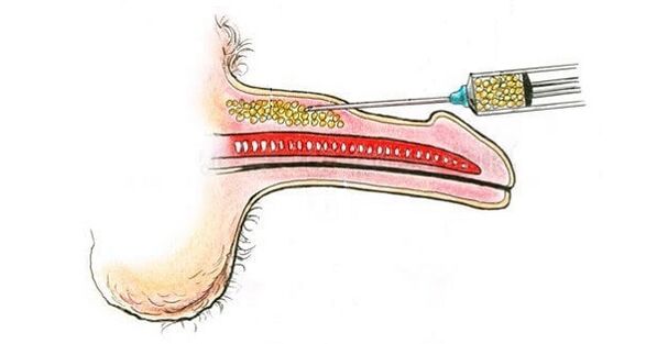 Hyaluronic acid injections in the cannon of a member in order to increase it